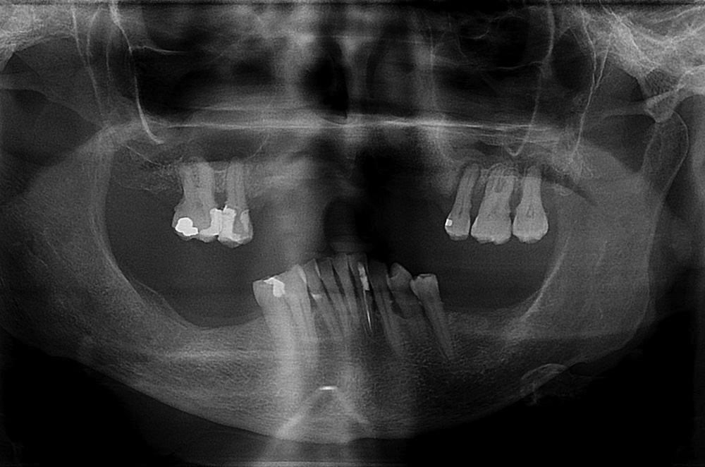 Prothèse complète sur implants dentaires Strasbourg 1